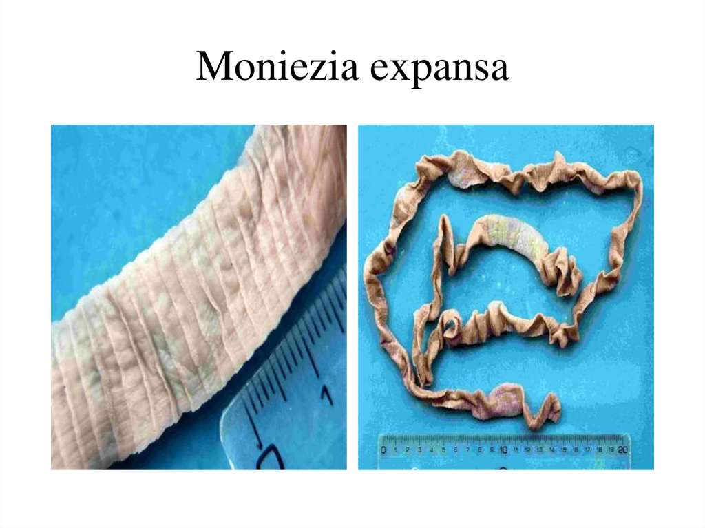 Monieziasis